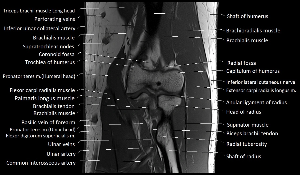 Elbow coronal anatomy image  cross sectional 3T MRI image 17.webp